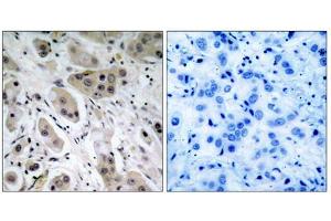 Immunohistochemical analysis of paraffin- embedded breast carcinoma, using Akt (Phospho-Ser473) Antibody. (AKT1 antibody  (pSer473))