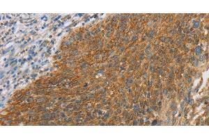Immunohistochemistry of paraffin-embedded Human cervical cancer tissue using ERK 3 Polyclonal Antibody at dilution 1:40 (MAPK6 antibody)