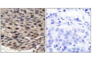 Immunohistochemical analysis of paraffin-embedded human breast carcinoma, using 4E-BP1 (phospho-Thr36) antibody. (eIF4EBP1 antibody  (pThr36))