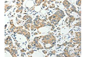 The image on the left is immunohistochemistry of paraffin-embedded Human colon cancer tissue using ABIN7191847(PFDN6 Antibody) at dilution 1/35, on the right is treated with synthetic peptide. (PFDN6 antibody)