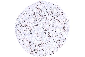 High Ki67 LI in a breast cancer NST (Ki-67 antibody  (AA 2293-2478))