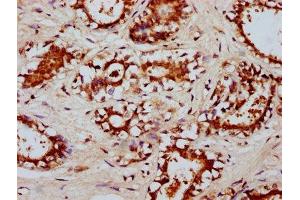 IHC image of ABIN7174060 diluted at 1:200 and staining in paraffin-embedded human breast cancer performed on a Leica BondTM system.