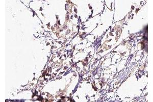 ABIN6276543 at 1/100 staining Human breast cancer tissue by IHC-P.