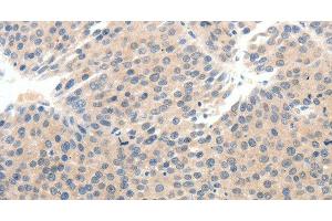 Immunohistochemistry of paraffin-embedded Human breast cancer tissue using SCN10A Polyclonal Antibody at dilution 1:25