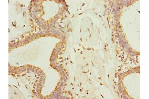 Immunohistochemistry of paraffin-embedded human breast cancer using ABIN7173083 at dilution of 1:100 (TMEM161A antibody  (AA 29-98))