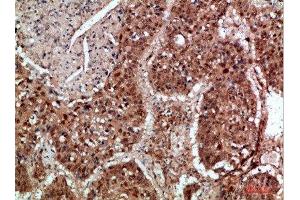 Immunohistochemical analysis of paraffin-embedded human-lung-cancer, antibody was diluted at 1:200 (TICAM1 antibody  (AA 663-712))