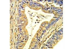 IHC analysis of FFPE human colon carcinoma stained with SOD1 antibody (SOD1 antibody  (AA 55-84))