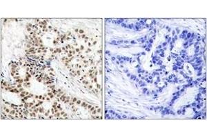 Immunohistochemistry analysis of paraffin-embedded human breast carcinoma, using BRCA1 (Phospho-Ser1423) Antibody. (BRCA1 antibody  (pSer1423))