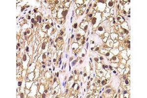 Immunohistochemistry of paraffin-embedded Human kidney cancer using TCEB3 Polyclonal Antibody at dilution of 1:100 (40x lens). (TCEB3 antibody)