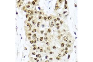 Immunohistochemistry of paraffin-embedded human lung cancer using TET2 antibody. (TET2 antibody)