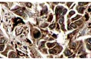 Immunohistochemistry of RFFL polyclonal antibody  shows strong cytoplasmic and membranous staining of tumor cells in cancerous human liver tissue. (RFFL antibody  (AA 1-363))
