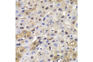 Immunohistochemistry of paraffin-embedded human liver cancer using MAD1L1 antibody. (MAD1L1 antibody  (AA 360-700))