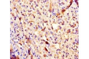 Immunohistochemistry of paraffin-embedded human melanoma using ABIN7154460 at dilution of 1:100 (PLA2G2D antibody  (AA 22-145))