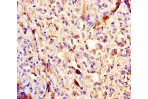 Immunohistochemistry of paraffin-embedded human melanoma using ABIN7154460 at dilution of 1:100 (PLA2G2D antibody  (AA 22-145))