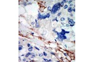 Formalin-fixed and paraffin-embedded human cancer tissue reacted with the primary antibody, which was peroxidase-conjugated to the secondary antibody, followed by DAB staining. (DYRK2 antibody  (N-Term))