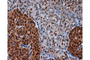 Immunohistochemical staining of paraffin-embedded Adenocarcinoma of colon tissue using anti-SRR mouse monoclonal antibody. (SRR antibody)