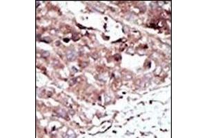 Formalin-fixed and paraffin-embedded human cancer tissue reacted with the primary antibody, which was peroxidase-conjugated to the secondary antibody, followed by AEC staining. (PHKG2 antibody  (N-Term))