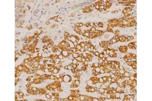 Immunohistochemical staining of human liver cancer tissue section with GOT2 monoclonal antibody, clone 14  at 1:100 dilution. (GOT2 antibody  (AA 225-430))