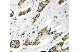 Anti-Hsp105 antibody, IHC(P) IHC(P): Human Mammary Cancer Tissue (HSPH1 antibody  (C-Term))