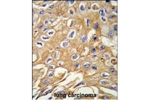 Formalin-fixed and paraffin-embedded human lung carcinoma tissue reacted with RIP3 (RIPK3) antibody (Center) (ABIN391273 and ABIN2841323) , which was peroxidase-conjugated to the secondary antibody, followed by DAB staining.
