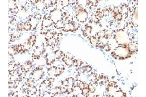 Formalin-fixed, paraffin-embedded human thyroid stained with TTF1 antibody (NX2. (TTF1 antibody)