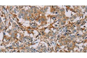 Immunohistochemistry of paraffin-embedded Human liver cancer tissue using CD204 Polyclonal Antibody at dilution of 1:30 (Macrophage Scavenger Receptor 1 antibody)