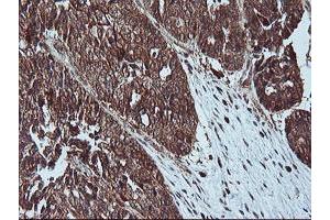 Immunohistochemical staining of paraffin-embedded Adenocarcinoma of Human ovary tissue using anti-LIMK1 mouse monoclonal antibody. (LIM Domain Kinase 1 antibody)