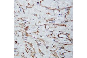 Anti-VEGF antibody, IHC(P) IHC(P): Human Lung Cancer Tissue (VEGFA antibody  (N-Term))