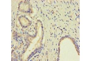 Immunohistochemistry of paraffin-embedded human prostate cancer using ABIN7173007 at dilution of 1:100 (TMPRSS11D antibody  (AA 201-418))