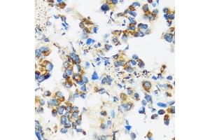Immunohistochemistry of paraffin-embedded human lung cancer using F antibody (ABIN3016158, ABIN3016159, ABIN3016160 and ABIN6219586) at dilution of 1:100 (40x lens). (APOBEC3F antibody  (AA 1-65))