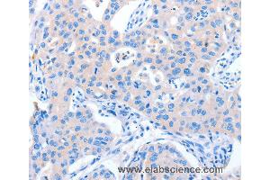 Immunohistochemistry of Human lung cancer using NUAK1 Polyclonal Antibody at dilution of 1:60 (NUAK1 antibody)