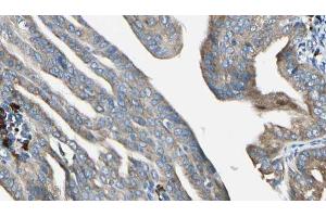 ABIN6272952 at 1/100 staining Human cervical cancer tissue by IHC-P. (SLC30A7 antibody  (N-Term))