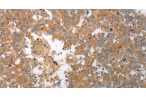 Immunohistochemistry of paraffin-embedded Human breast cancer tissue using SHH Polyclonal Antibody at dilution 1:40 (Sonic Hedgehog antibody)