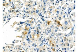ABIN6260628 and ABIN6276794 at 1/100 staining Human lung cancer by IHC-P. (CD46 antibody  (N-Term))
