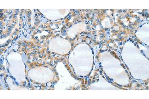 Immunohistochemistry of paraffin-embedded Human thyroid cancer tissue using HID1 Polyclonal Antibody at dilution 1:50 (HID1/DMC1 antibody)