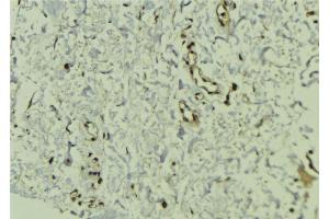 ABIN6272454 at 1/100 staining Human breast cancer tissue by IHC-P. (Cytidine Monophosphate (UMP-CMP) Kinase 1, Cytosolic (CMPK1) (N-Term) antibody)