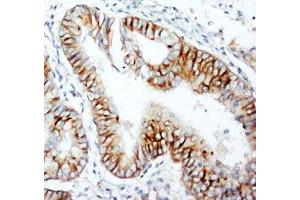 IHC-P: CCR5 antibody testing of human rectal cancer tissue (CCR5 antibody  (N-Term))