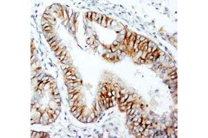 IHC-P: CCR5 antibody testing of human rectal cancer tissue