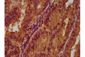 IHC image of ABIN7162774 diluted at 1:300 and staining in paraffin-embedded human endometrial cancer performed on a Leica BondTM system. (PGLYRP1 antibody  (AA 22-196))