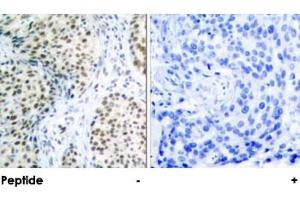Immunohistochemical analysis of paraffin-embedded human breast carcinoma tissue using ATM polyclonal antibody . (ATM antibody  (Ser1981))