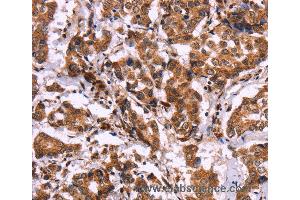 Immunohistochemistry of Human liver cancer using CARD11 Polyclonal Antibody at dilution of 1:40 (CARD11 antibody)