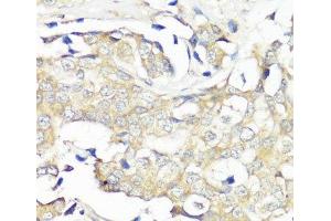 Immunohistochemistry of paraffin-embedded Human breast cancer using EIF3B Polyclonal Antibody at dilution of 1:100 (40x lens). (EIF3B antibody)