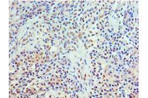Immunohistochemistry of paraffin-embedded human breast cancer using ABIN7172022 at dilution of 1:100 (TXNRD2 antibody  (AA 100-310))