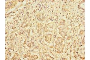 Immunohistochemistry of paraffin-embedded human pancreatic cancer using ABIN7165266 at dilution of 1:100 (DIAPH2 antibody  (AA 1-120))