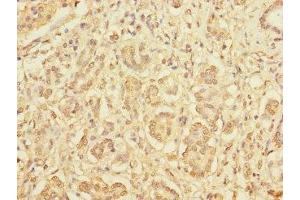 Immunohistochemistry of paraffin-embedded human pancreatic cancer using ABIN7165266 at dilution of 1:100