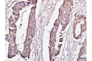 Paraformaldehyde-fixed, paraffin embedded human colon cancer, Antigen retrieval by boiling in sodium citrate buffer (pH6) for 15min, Block endogenous peroxidase by 3% hydrogen peroxide for 30 minutes, Blocking buffer (normal goat serum) at 37°C for 20min, Antibody incubation with 	DEPTOR Polyclonal Antibody, Unconjugated  at 1:500 overnight at 4°C, followed by a conjugated secondary and DAB staining. (DEPTOR antibody  (AA 56-170))