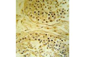 Immunohistochemistry analysis in formalin fixed and paraffin embedded human testis carcinoma reacted with  BXDC4 / IMP4 Antibody (C-term) followed by peroxidase conjugation of the secondary antibody and DAB staining. (IMP4 antibody  (C-Term))