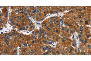 Immunohistochemistry of paraffin-embedded Human liver cancer tissue using CATSPER3 Polyclonal Antibody at dilution 1:60