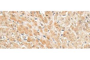 Immunohistochemistry of paraffin-embedded Human liver cancer tissue using TRUB1 Polyclonal Antibody at dilution of 1:85(x200)