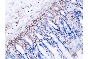 Formalin-fixed and paraffin embedded human breast carcinoma labeled with Anti DBC2 Polyclonal Antibody, Unconjugated (ABIN706241) at 1:200 followed by conjugation to the secondary antibody and DAB staining (RHOBTB2 antibody  (AA 631-727))